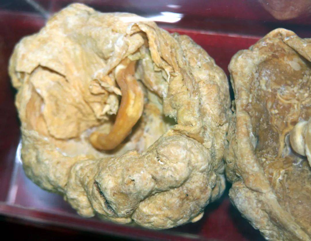 人大代表建议：允许产妇将胎盘捐给药企制成药品！湖南省药监局：支持探索！ 